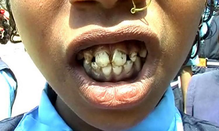 dental fluorosis