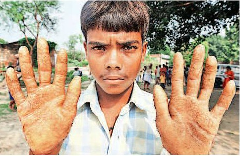 A boy in Ballia, shows skin lesions caused by arsenic poisoning Source:National Level Monitor Report