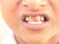 dental fluorosis