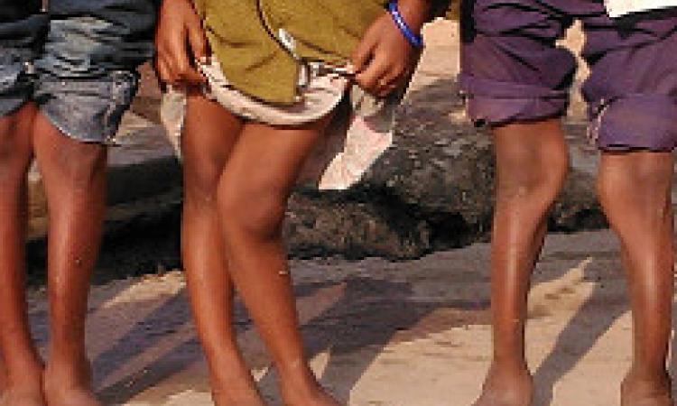 Fluorosis