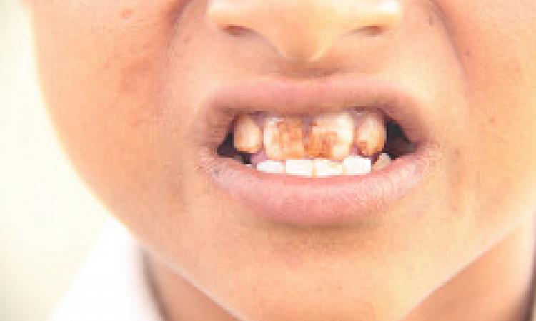 dental fluorosis