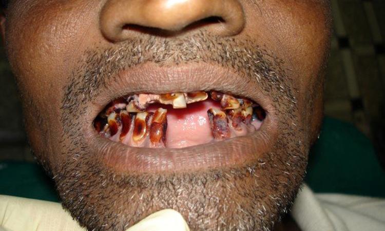 dental fluorosis