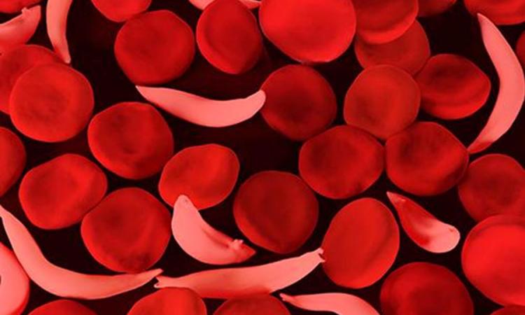 सिकल-सेल बीमारी से पीड़ित व्यक्ति के खून में सामान्य (गोलाकार) व सिकल (हँसियानुमा ) कोशिकाएं (फोटो साभार: नेशनल ह्यूमन जीनोम रिसर्च इंस्टीट्यूट, 2018)