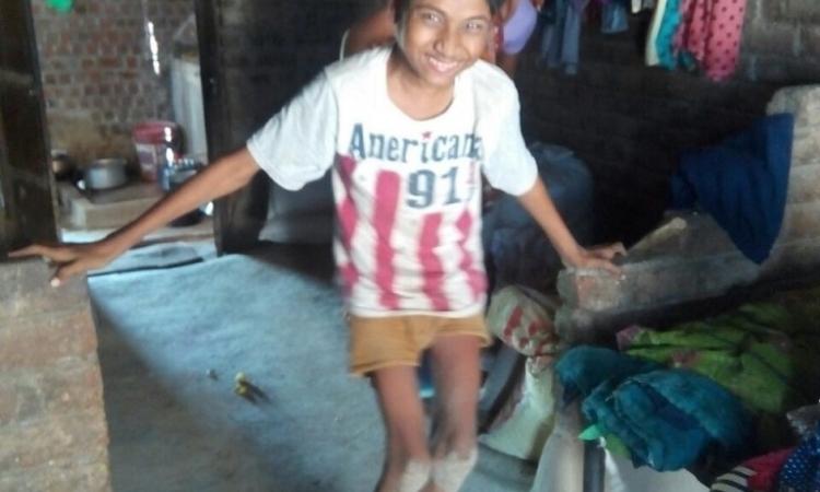 Dilip in Bankpura village, Dhar, MP suffers from skeletal fluorosis (Source: Dalpat & Heena)